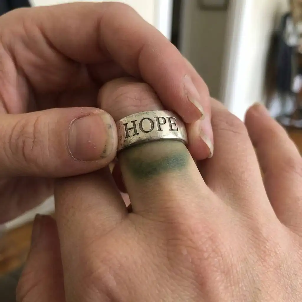 A dark green mark on a woman’s finger after removing a shiny, inexpensive Hope Ring.